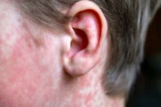 Health officials report measles exposure at Phoenix Sky Harbor International Airport